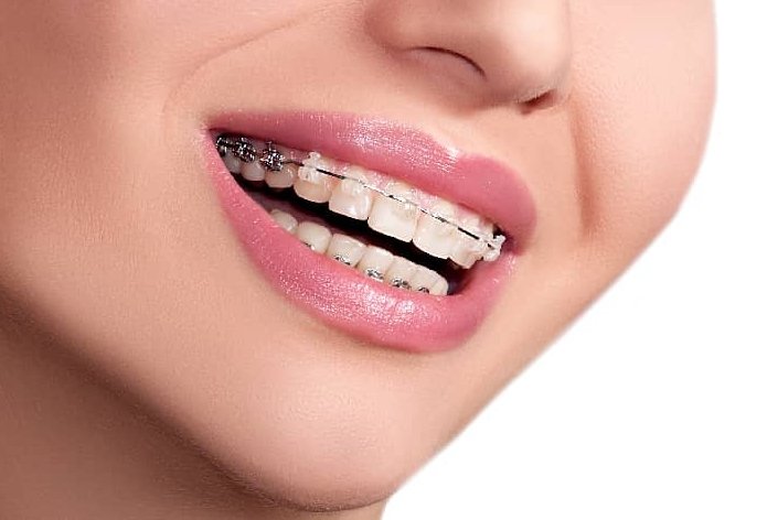 Helping avoid metal allergies and providing  lasting protection