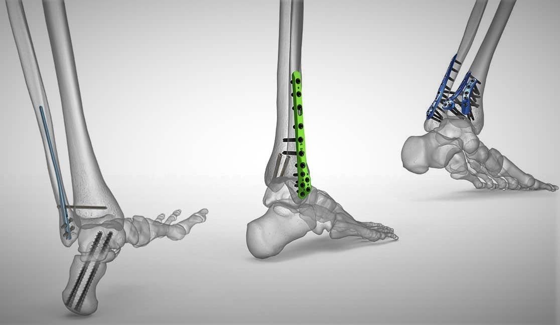 Medical Implants of Titanium Wire