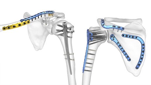 Solving Fatigue Failure in Orthopedic Implants
