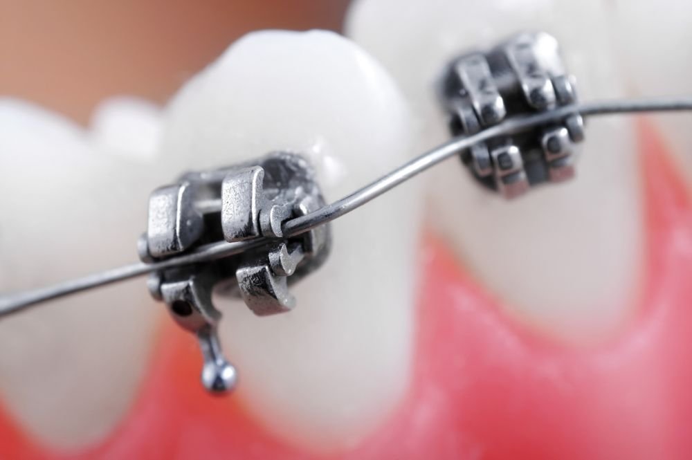 Balancing Flexibility and Strength of Stainless Steel Orthodontic Wires